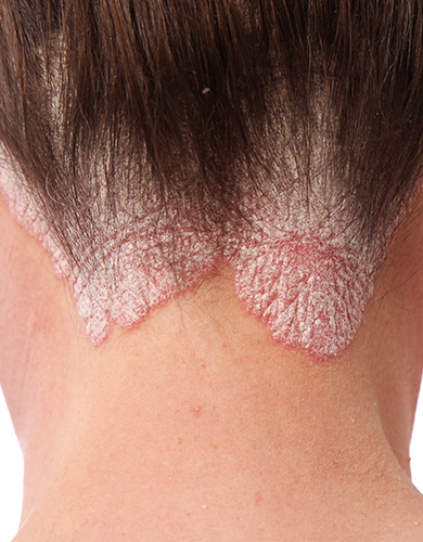Enfermedades autoinmunes de la piel: Psoriasis