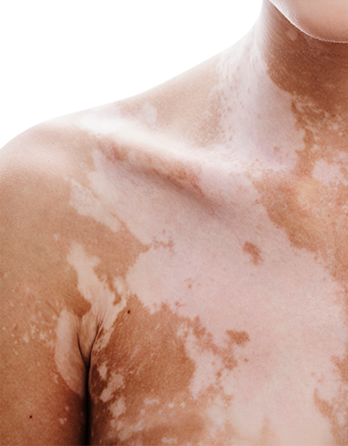 Enfermedades autoinmunes de la piel: Vitiligo
