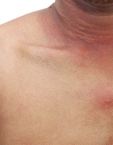 Enfermedades autoinmunes de la piel: Dermatitis