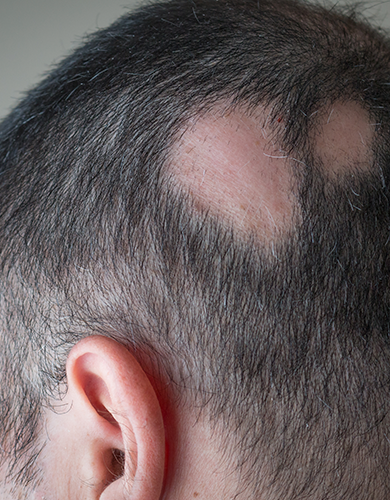Enfermedades autoinmunes de la piel: Alopecias